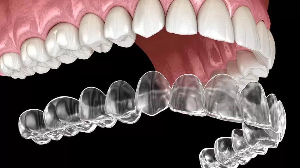 Şeffaf Plak (Invisalign)